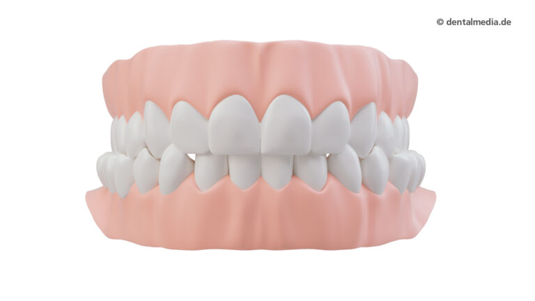 Zahnfehlstellung Kreuzbiss