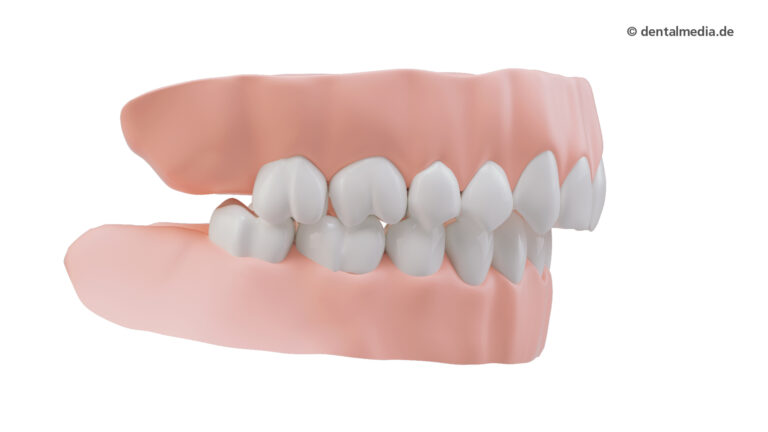 Zahnfehlstellung Rückbiss